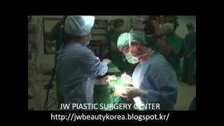 韩国鼻整形现场演示手术 Koran Rhinoplasty live surgery