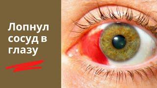 Кровоизлияние субконъюнктивальное в глазу \ лопнул сосуд в глазу - как лечить, что делать?