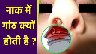 नाक में गांठ होना खतरनाक जानिए कारण और लक्षण । Naak Me Ganth Kyu Hoti । Boldsky *Health