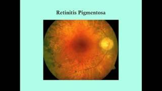 Retinitis Pigmentosa - CRASH! Medical Review Series