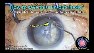 CataractCoach™ 2160: How to save this run-out capsulorhexis?