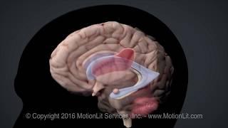 Intracerebral Hemorrhage Stroke