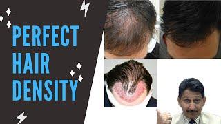 Do you want perfect hair density? | Best Hair Transplant  Doctor in Kolkata Dr. Manoj Khanna