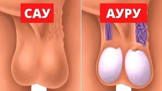 Байқамайтын ауру! Варикоцеле қалай пайда болады? варикоцеле ауруы. Жыныстық мүше ауруы.