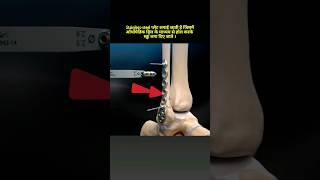 Ankle joint Fibula Bone Fracture Surgery | 3D Animation #shorts