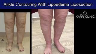 Ankle contouring with lipoedema liposuction | Cankle Surgery | The Karri Clinic | Mr Vasu Karri