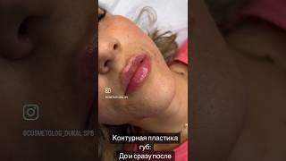 Губы - Чайка ?! Как исправить …. До и сразу после контурной пластики #губы #beauty #косметолог