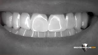 Brighter Image Lab BilVeneers™ The Future of No Dentist Dental Veneers!