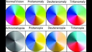 Blue-weak color blindness