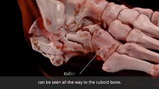 Anatomage Table Patient Case 120 - Calcaneus Fracture