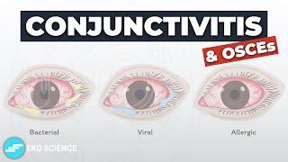 Conjunctivitis: Bacterial, Viral & Allergic - Symptoms, Diagnosis, Treatment & OSCEs