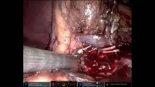 Robotic nephroureterectomy Dr Manish Gupta