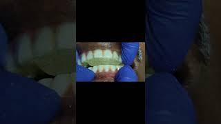 Anterior deprogrammer for full arch implant prosthesis! ##shorts