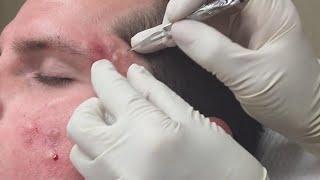 Super Satisfying Blackhead Removal