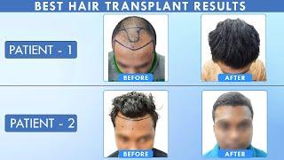 Best Hair Transplant Result || Hairfree & Hairgrow Clinic Bhopal || By  Dr. Ankit Jain and Team