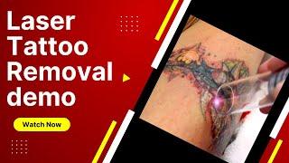 Laser Tattoo Removal Q-Yag Laser Demo : Dr. Undo Tattoo