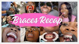 The Journey to a Perfect Smile: Adult Braces Recap #perfectsmile #bracesupdate