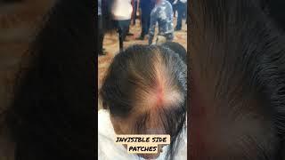 INVISIBLE SIDE PATCHES | COVERAGE | HUMAN HAIR | #shorts #youtubeshorts