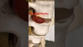 Lower back pain | L4-L5, L5-S1 Problem | Slip disc, Disc Bulge, Sciatica #shorts