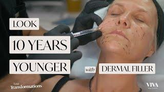 Look 10 Years Younger With Dermal Filler | Before & After | Total Transformations Ep 5