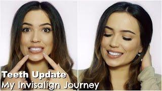 Invisalign Update Journey | More Refinements