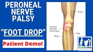 Peroneal Nerve Palsy with Foot Drop