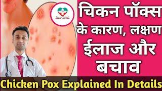 Chicken Pox in hindi! Chicken pox Symptoms ! Dr.K.S.Chougule.