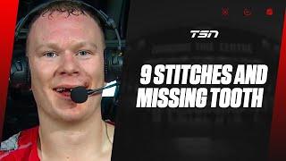 Tkachuk scores game winner after losing a tooth and getting nine stitches