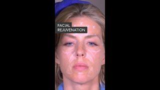 Facial Rejuvenation using Filler & Botox | Dr. Hooman Khorasani