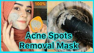 How To Remove Dark Spots On Face | Acne Spots | 100% Results | Dietitian Aqsa