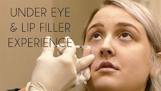 Under Eye Filler Experience & Footage | Before/After, Cost, Pain, Bruising & My Lips