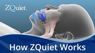 Want to Stop Snoring? Learn How ZQuiet Anti Snoring Mouthpieces Work