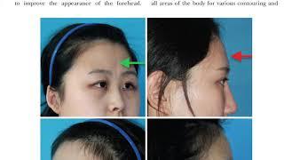 Forehead Fat Grafting for Asians. Plastic Surgery Hot Topics with Rod J. Rohrich, MD