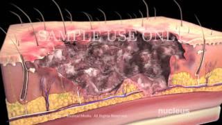 Burns: Classification and Treatment