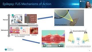 Focused Ultrasound and Epilepsy
