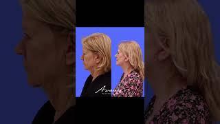 Mini Facelift Before And After | Avance Plastic Surgery Institute: Dr. Erez Dayan | Reno, NV