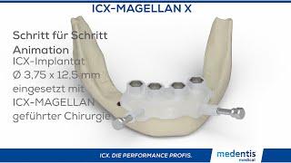 ICX Magellan X® geführte Implantation animiert!