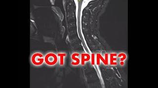 Understand Your Scan: Multiple Sclerosis MRI Cervical Spine