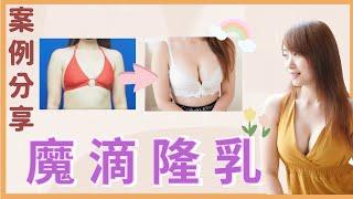 【#魔滴隆乳｜真實見證】產後媽咪的自信秘訣-Motiva一代魔滴！馬爾地夫我來了！｜整形外科 #陳大正醫師