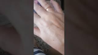 ОШПАРИЛА РУКУ КИПЯТКОМ ПАНТЕНОЛ ПОМОГАЕТ  #нашажизньлн #нашажизньлн