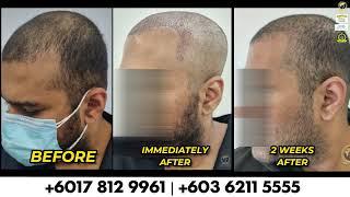 ( INCREASE DENSITY ) 2 WEEKS AFTER SMART FUE HAIR TRANSPLANT | GLOJAS AESTHETIC CLINIC