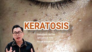 Kutil kutil kecil? Ini namanya Keratosis Sebhoreic, Laser yuk! #sebhoreickeratosis #laserco2