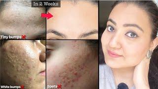 कितने भी मुश्किल *TINY BUMPS* सफ़ेद छोटे दाने WHITE BUMPS, SPOTS हों, इस Remedy से होगा 100% इलाज़