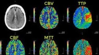 #CT# #PERFUSION# #BRAIN#  CT-scan perfusion imaging and processing video.........how it looks in CT.