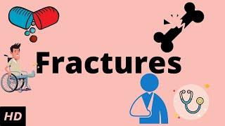 Fractures, Causes, Signs and Symptoms, Diagnosis and Treatment.