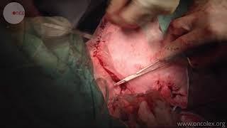 Mandibulectomy with fibula graft