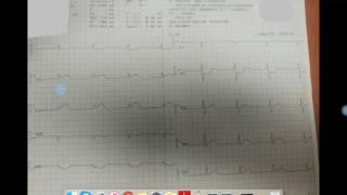 Ecg Shot vom 25.07.2017, Teil 1 (deutsch)