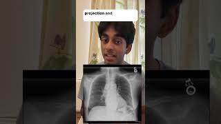 Chest X-Ray Interpetation: A Case Walkthrough! #shorts #osces #osceazy