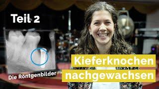 Kieferknochen nachgewachsen Teil 2 - Details & Röntgenbilder
