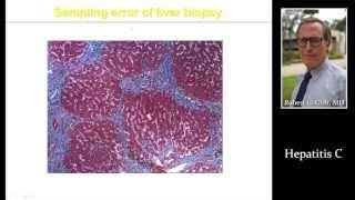 HEPATITIS C (HCV) by Dr. Robert Gish